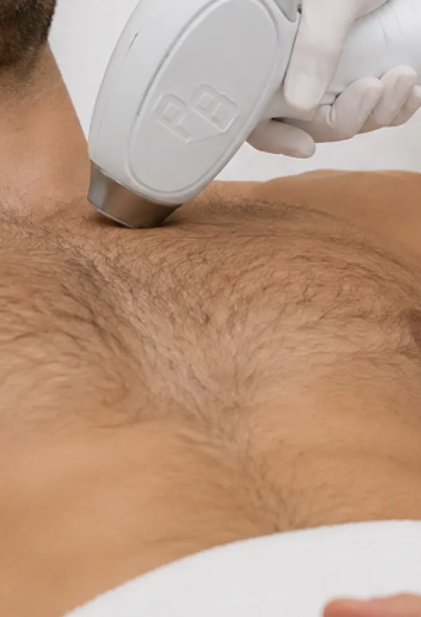 Laser hair removal handpiece applied to the chest