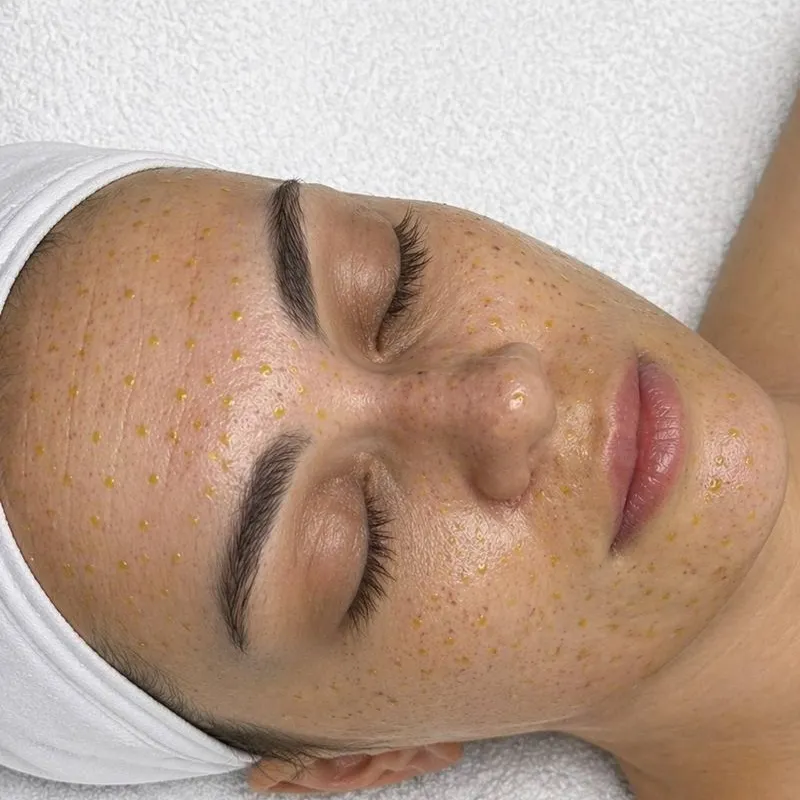 A face at rest after a peel, freckles visible across the cheeks