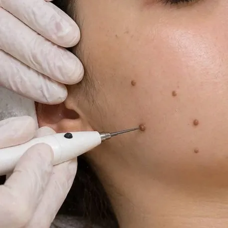 A plasma pen held against raised moles on the cheek