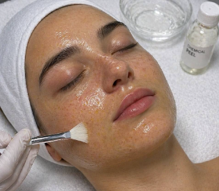 Light chemical peel treatment