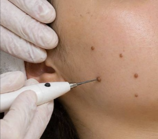 Electrocoagulation with Plasma Pen treatment
