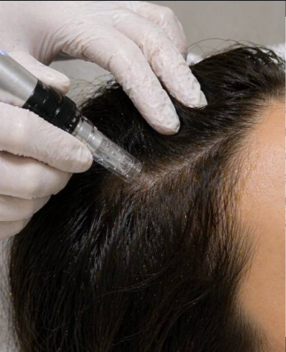 Scalp microneedling treatment
